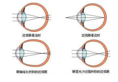 近视矫正都有哪些方法？带来阐述了解近视调节详情