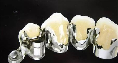 上海钴铬烤瓷牙价格多少钱？认清牙齿情况