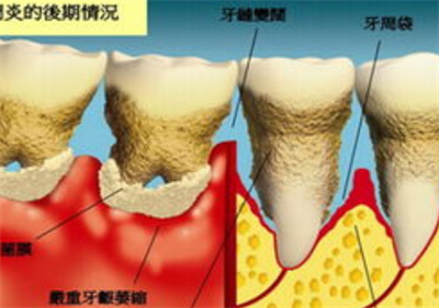 牙周刮治多少钱一次？价格带来具体阐述！