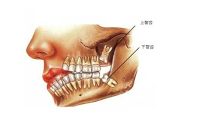 冠周炎拔牙多少钱？价格贵吗？看介绍