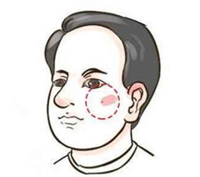 激光点痣多少钱？需注意哪些问题，一起来看