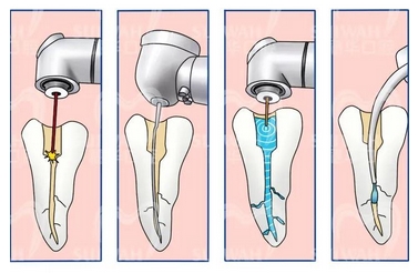根管调节的步骤过程是怎么样的？医生调节过程分享~费用标准公开啦！