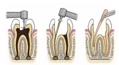 根管调节的步骤过程是怎么样的？医生调节过程分享~费用标准公开啦！