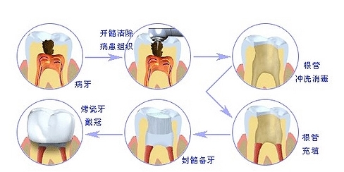 根管调节的步骤过程是怎么样的？医生调节过程分享~费用标准公开啦！