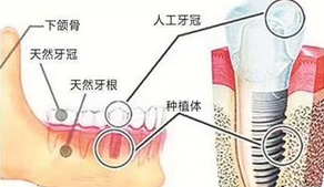 北京大学人民医院种植牙价格是多少？使用寿命有多久？种牙不盲目，医生来帮你！