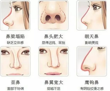 北大医院隆鼻多少钱？整形费用一览无余！揭秘隆鼻价格~
