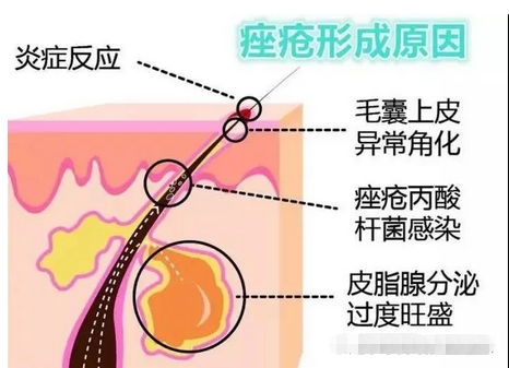 痤疮的调节价格是多少？怎样去除才彻底呢？注意事项在线解读~