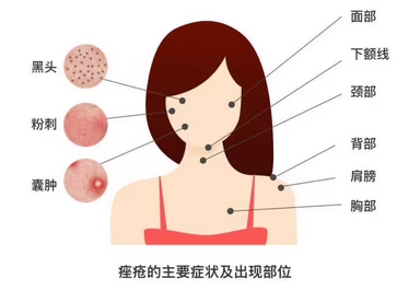 痤疮的调节价格是多少？怎样去除才彻底呢？注意事项在线解读~