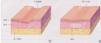 像素激光去疤好不好？原理分析介绍！注意事项又有哪些呢？