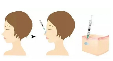 玻尿酸注射隆鼻的价格是多少？完全看不出整过痕迹？原理又是什么呢？
