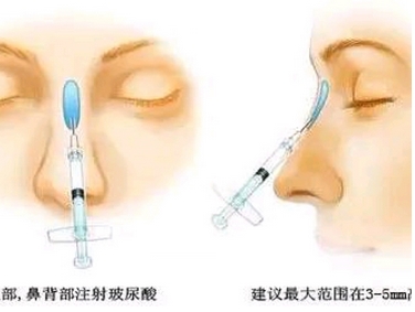 玻尿酸注射隆鼻的价格是多少？完全看不出整过痕迹？原理又是什么呢？