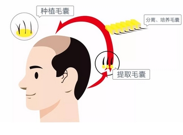 北京301医院植发医生如何？植发原理是什么？热门保留项目等你来体验！