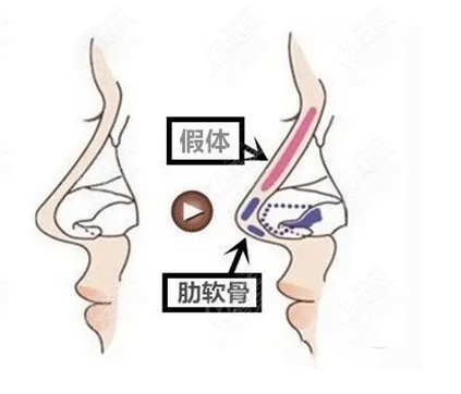 肋软骨隆鼻的优势有哪些？隆鼻过程记录分享！又要注意哪些呢？