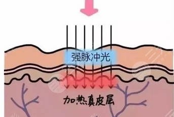 北京航空总医院光子嫩肤怎么样？被称为医美“万金油”？附专家详细资料~