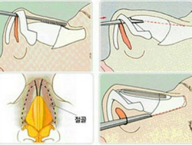 北京世纪坛医院整形美容外科驼峰鼻矫正价格是多少？实力专家贴心科普！附价格公开~