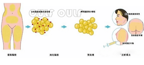 北京协和医院脂肪填充专家有哪些？医生个人信息|热门项目地点评!五位专家介绍~