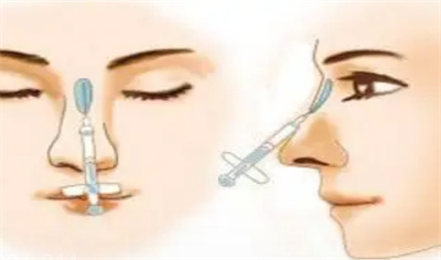 注射隆鼻手术多少钱？不同鼻子基础条件影响价格吗？