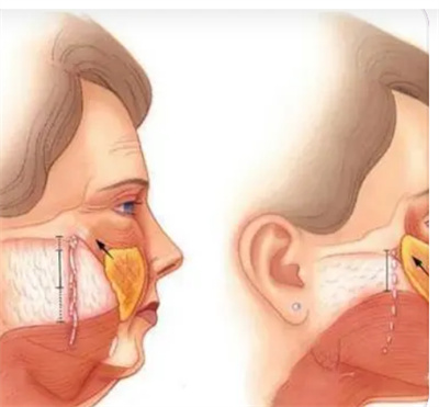 拉皮手术的副作用有哪些？拉皮手术效果怎么样？