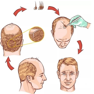 北京304医院植发和大麦对比！看哪家植发技术好，性价比高！看看这篇文章对你有帮助吗~