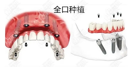 现在种一颗牙要多少钱？种植牙齿的费用受哪些因素的影响？快来点击收藏下来吧！