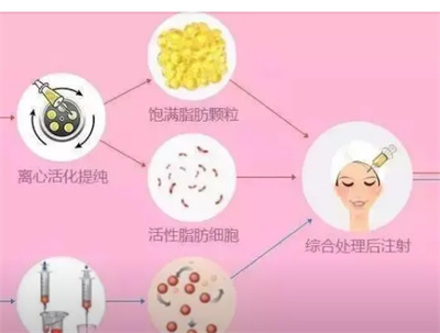 注射垫下巴多少钱?新手小白调节前必看事项！