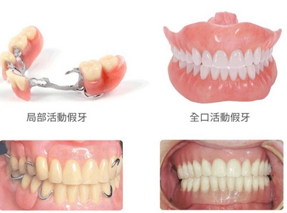 装一颗假牙要多少钱？除了假牙的材质，哪些因素还影响假牙价格？附各种假牙售价介绍~