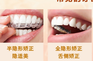 广州矫正牙齿多少钱？牙齿矫正有哪些方法？及时矫正，受益终生！