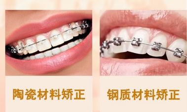 广州矫正牙齿多少钱？牙齿矫正有哪些方法？及时矫正，受益终生！