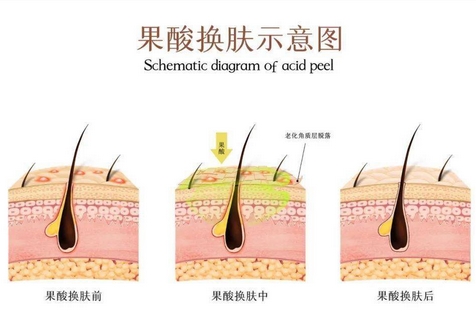果酸换肤价格多少钱？哪些因素影响果酸换肤价格？医美小白get指南~