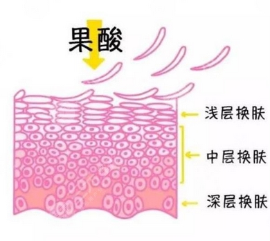 果酸换肤价格多少钱？哪些因素影响果酸换肤价格？医美小白get指南~