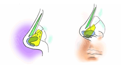 自体软骨隆鼻好不好？可以维持多久呢？隆鼻之后注意事项有哪些？