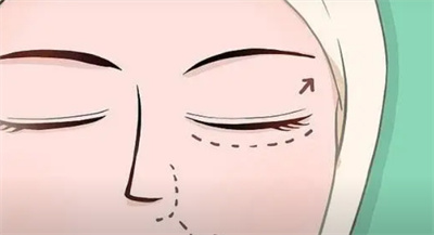 韩式双眼皮价格多少？韩式双眼皮如何操作的？