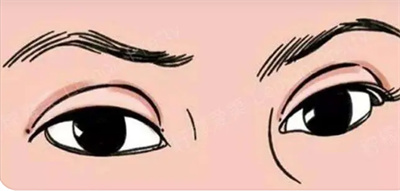 韩式双眼皮价格多少？韩式双眼皮如何操作的？