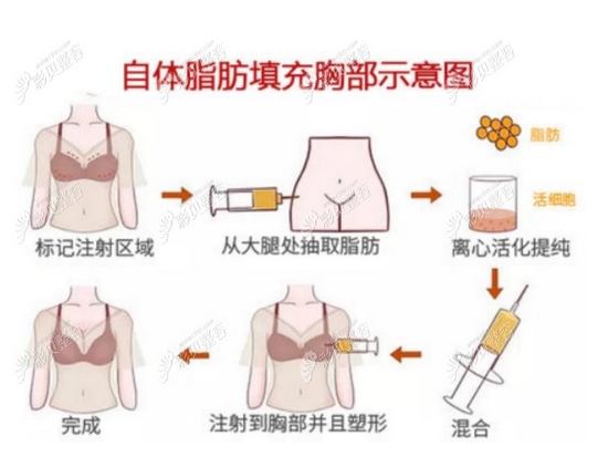 自己脂肪的隆胸手术多少钱？费用明细|手术过程介绍！注意事项出炉~