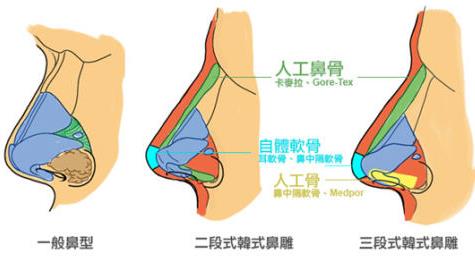 重一医院张恒术怎么样？做隆鼻手术之后多久可以恢复自然看见效果？