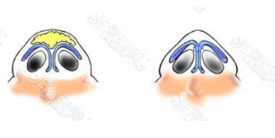 鼻翼肥大怎么办？鼻翼肥大手术需要多少钱？手术前后注意事项有哪些？