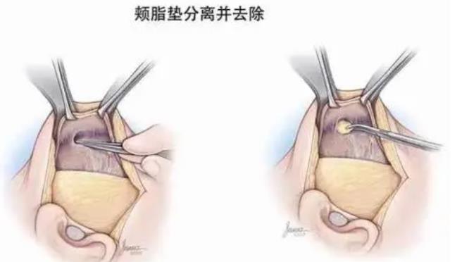 去颊脂垫对瘦脸有效吗？手术过程和工作原理是什么？