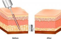 抽脂形体改良怎么做？吸脂技术的调节原理怎么样?