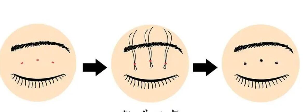成都游晓波双眼皮价格贵不贵？医生实力点评及真人案例图展示！