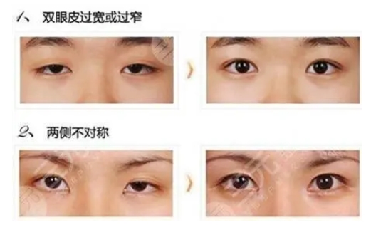 北大深圳医院整形科李天石双眼皮怎么样？医生|科室详细资料介绍！精选案例等你查看~