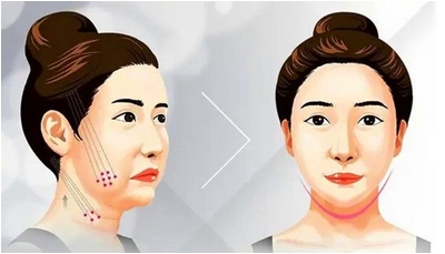 整瓜子脸需要多少钱？整瓜子脸是什么原理？提升魅力值~