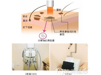 激光调节雀斑的价格怎么样？激光调节雀斑是什么原理呢？附注意事项分享~