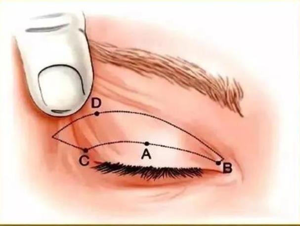 上眼皮松弛矫正方法是怎样的？矫正的方法有什么优势？