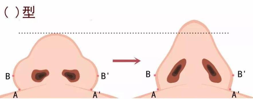 鼻翼缩小前后对比变化大吗？做手术前后需要注意哪些事情？