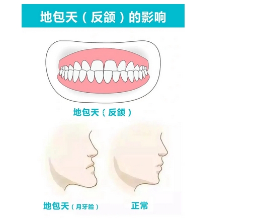 调节牙齿地包天的方法是什么？矫正需要多长时间？矫正优点有哪些~