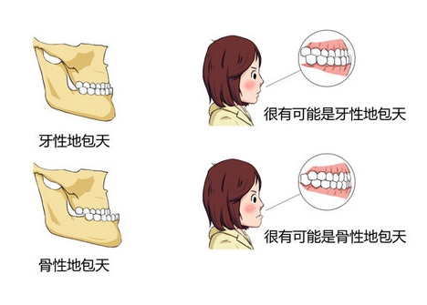 调节牙齿地包天的方法是什么？矫正需要多长时间？矫正优点有哪些~