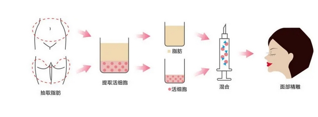 自体脂肪丰苹果肌如何？真实案例全过程，打造精致芭比脸！