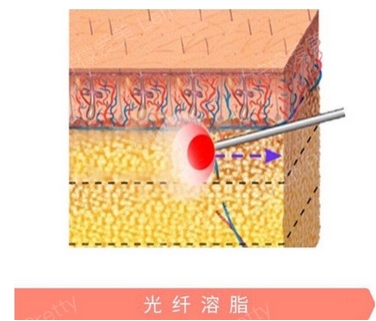 光纤溶脂好不好？光纤溶脂是什么呢？需要注意哪些方面呢~