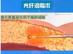 光纤溶脂好不好？光纤溶脂是什么呢？需要注意哪些方面呢~