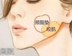 去颊脂垫有副作用吗？运用了哪些原理？去颊脂垫适合哪些人做？